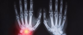 5 Things Arthritis Patients Should Know About Joint Deformity