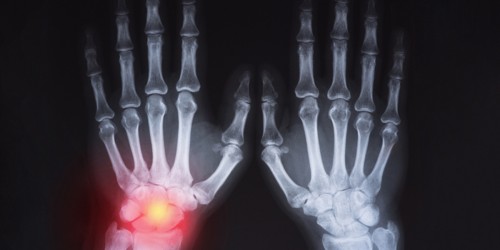 5 Things Arthritis Patients Should Know About Joint Deformity
