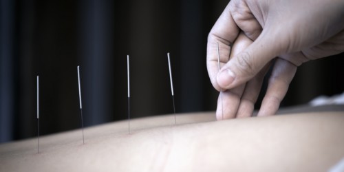 6 Things Multiple Sclerosis Patients Should Know About Acupuncture