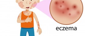 6 Things You Should Know About Eczema (Atopic Dermatitis): Causes, Symptoms, Diagnosis And Treatment