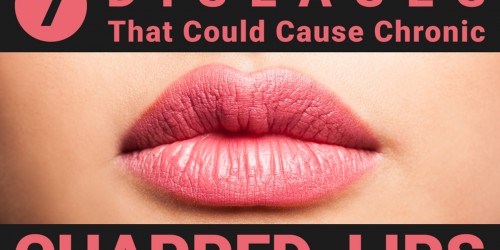 Seven Diseases That Could Cause Chronic Chapped Lips (Cheilitis)