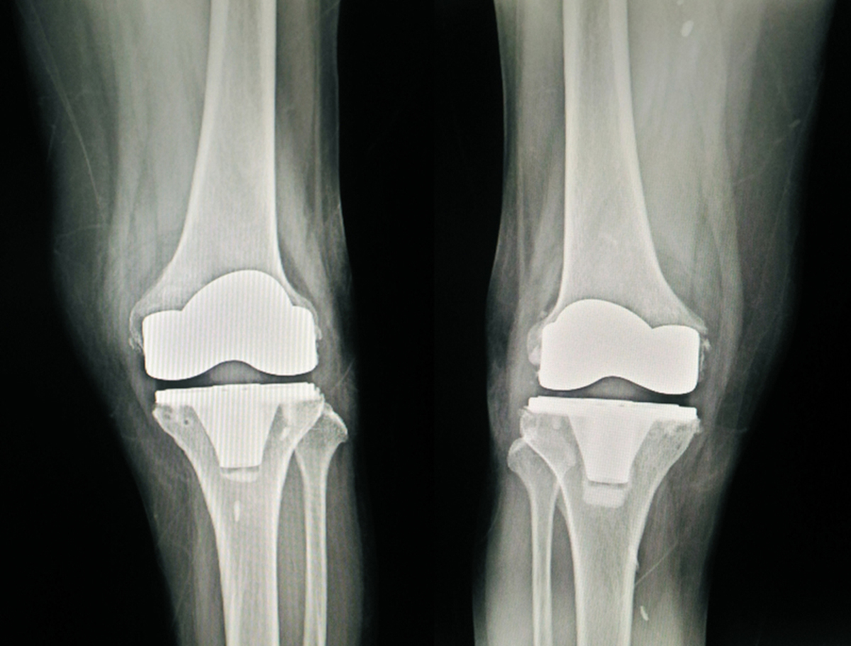8 Things You Should Know About Complex Or Revision Knee Replacement