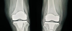 8 Things You Should Know About Complex Or Revision Knee Replacement Surgery
