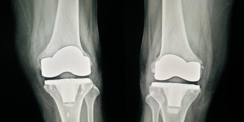 8 Things You Should Know About Complex Or Revision Knee Replacement Surgery