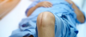8 Things You Should Know About Total Knee Replacement