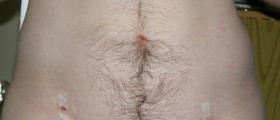 Gastrointestinal Stromal Tumors: Warning Signs, Diagnosis And Treatment