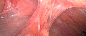 Abdominal Adhesions Can Cause Bowel Obstruction