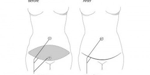 Tummy Tuck: Abdominoplasty procedure
