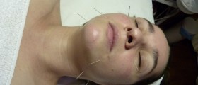 Berkley Acupuncture Method To Prevent Miscarriage