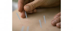 Chinese Medicine, Health and Wellness-Acupuncture