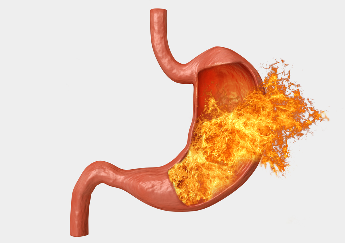 everything-you-need-to-know-about-acid-reflux-disease-medfitnetwork