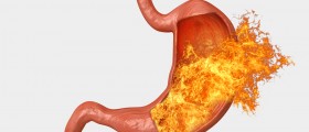 Acid Reflux and Heartburn: How to treat it?