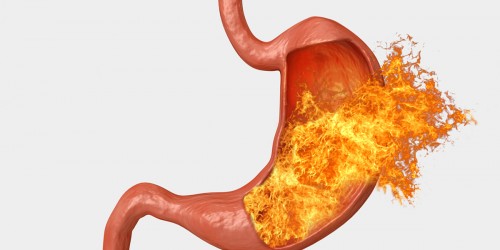 Acid Reflux and Heartburn: How to treat it?