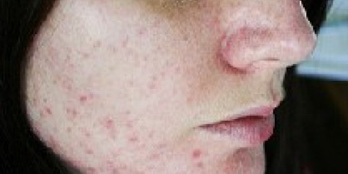 Top Acne Treatments - Proven Remedies to Get Rid of Acne Fast