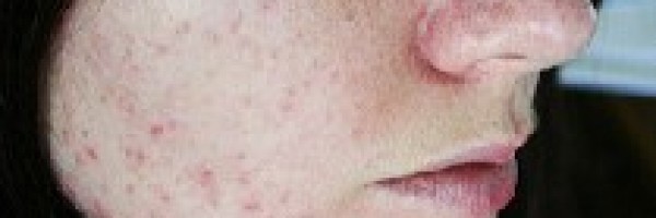 Top Acne Treatments - Proven Remedies to Get Rid of Acne Fast