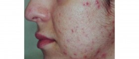 Food and acne