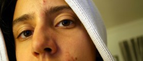 Acne: What Works and What not?