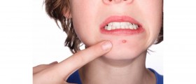 Natural and Home Remedies for Acne (Pimples)