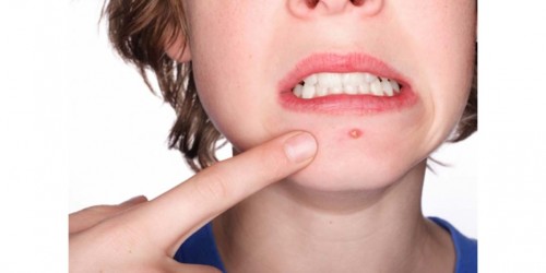 Natural and Home Remedies for Acne (Pimples)