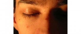 Adult Acne Facts: Causes and Cure