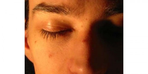 Adult Acne Facts: Causes and Cure