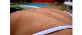 Acupuncture And Pain Relief