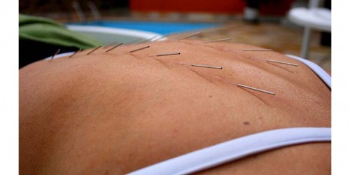 Acupuncture And Pain Relief