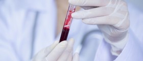 Acute Hepatitis C: Symptoms, Causes, And Treatments
