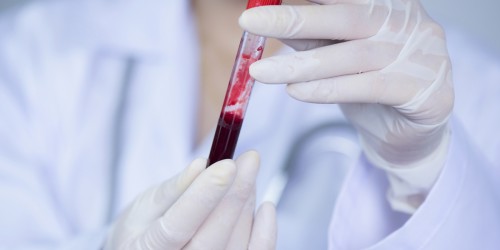 Acute Hepatitis C:  Symptoms, Causes, And Treatments