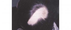 Alopecia areata