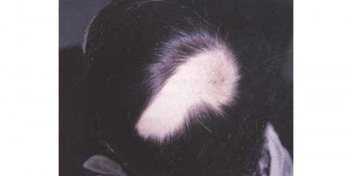 Alopecia areata