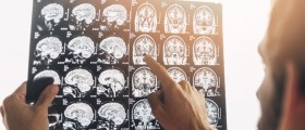 ALS Diagnosis: 6 Diagnostic Tests Doctors Use To Exclude Other Diseases and Diagnose ALS