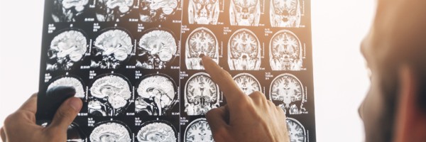 ALS Diagnosis: 6 Diagnostic Tests Doctors Use To Exclude Other Diseases and Diagnose ALS