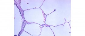 Atelectasis Signs and Symptoms
