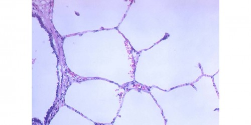 Atelectasis Signs and Symptoms