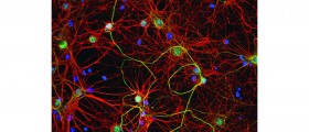 Magnet Therapy May Relieve Mild Alzheimer’s Disease