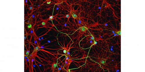 Magnet Therapy May Relieve Mild Alzheimer’s Disease