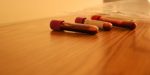 Down syndrome: Prenatal Screening During Pregnancy