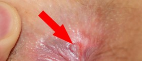 Anal Fissures: A Pain That Is Hard to Discuss