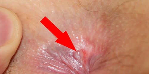 Anal Fissures: A Pain That Is Hard to Discuss