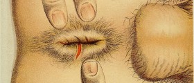 Anal Fissure Recovery