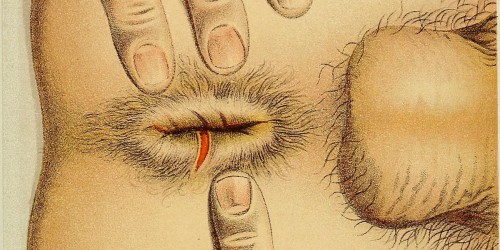 Anal Fissure Recovery