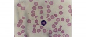 AIHA - Autoimmune Haemolytic Anaemia