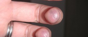 Study: Iron Deficiency Anemia Increases The Risk Of Stroke
