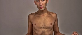 Eating Disorders (Anorexia, Bulimia and Binge Eating) Among Males Becoming Common