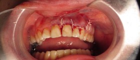 What is An Apicoectomy?