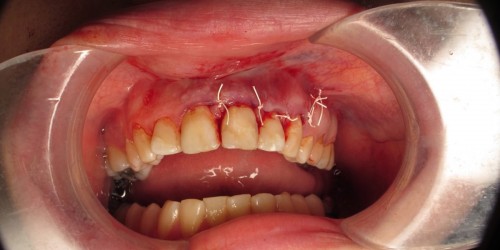 What is An Apicoectomy?