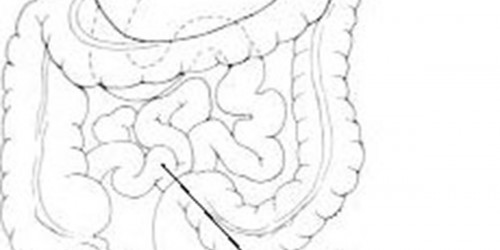How to recognize the Signs of Acute Appendicitis?