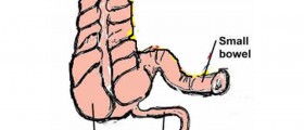 Appendix removal: When is Appendectomy really needed?