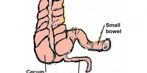 Appendix removal: When is Appendectomy really needed?